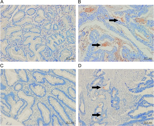 Representative images of CEACAM1 staining (A) Little to no CEACAM1 staining in upper normal gastrointestinal tissues. (B) CEACAM1 staining mainly in secreted forms (from upper gastrointestinal cancer tissues). (C) Little to no CEACAM1 staining in lower normal gastrointestinal tissues. (D) CEACAM1 staining is more intense at the invasion front than at the luminal surface (from lower gastrointestinal cancer tissues). The arrows indicate positive staining for CEACAM1 (red color, 200 × microscopic field).