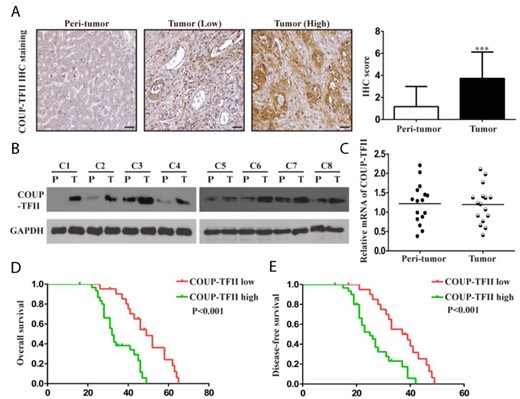COUP-TFII expression positively correlates with poor prognosis of ICC patients (A) COUP-TFII expression was detected by IHC in 52 pairs of ICC and adjacent non-tumorous tissues using a specific antibody against COUP-TFII. Scale bar: 100 µm. (B) Representative western blot analysis of COUP-TFII expression in 8 pairs of ICC and adjacent non-tumorous tissues. P, peritumor; T, tumor. (C) Real-time PCR analysis of COUP-TFII mRNA expression in 16 pairs of ICC and adjacent non-tumorous tissues. (D, E) Kaplan–Meier plot of overall survival and disease-free survival of patients with ICC stratified by COUP-TFII expression. The log-rank test was used to compare differences between groups (n = 52). Data are expressed as the mean ± SD. The results are representative of three independent experiments. ***P < 0.001.