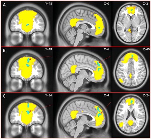 Significant differences between groups in DMN FC when controlling for age, sex, and inattention symptoms. The yellow underlay depicts the anterior DMN mask. Part A: Lower anterior DMN (contrast 1, cluster 1), group with OI > group with multiple concussion. Part B: Upper anterior DMN (contrast 2, cluster 1), indicated with a red arrow, group with single concussion > group with multiple concussion. Part C: Upper anterior DMN (contrast 2, cluster 1), indicated with a red arrow, group with single concussion > group with multiple concussion.