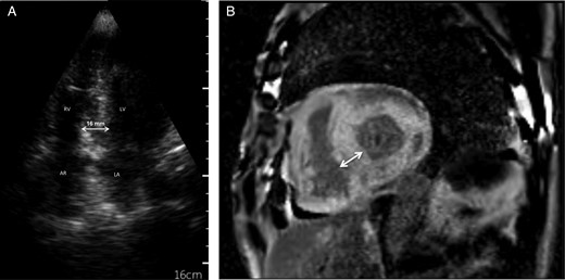 (A) Cardiac image Section 4 cavities of an ultraportable screening echocardiograph: thickening of the interventricular septum measured at 16 mm with a grained aspect in the ‘brightness’ of the myocardium. LV, left ventricle; RV, right ventricle; LA, left atrium; AR, right atrium; (B) Cardiac MRI section short-axis T1 sequence with injection of gadolinium: late diffuse circumferential enhancement of the myocardium with an interventricular septum measured at 22 mm.