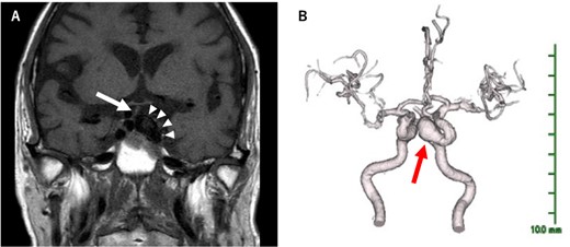(A) The arrow heads indicate the cavernous carotid artery aneurysm, and the arrow indicates the shifted pituitary stalk. A large cavernous carotid aneurysm compressing the pituitary gland, with the pituitary stalk deviated to the right. (B) Three-dimensional magnetic resonance angiography (3D-MRA) images show bilateral internal carotid arteries with large extensions and meanders. A large aneurysm has formed in the left internal carotid artery (arrow). The size of the cavernous carotid aneurysm is 16 × 9 mm.