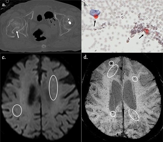 (a) CT showing a right undisplaced femoral neck fracture (Garden Stage II) (white arrowhead). (b) Blood cytology with oil red staining showing a small number of fat droplets in the background and a small number of cells that appeared to be histiocytes with fat in their cytoplasm (black arrowheads). (c) Diffusion-weighted MRI showing scattered punctate hyperintense signals in the watershed regions of the bilateral cerebrum (white circles). (d) Susceptibility-weighted imaging (SWI) showing diffuse hypointense lesions in the cerebrum (white circles).