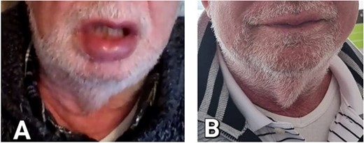 Clinical Photography (A) demonstrating swelling of the lower lip (B) demonstrating resolution of the lower lip swelling after treatment.