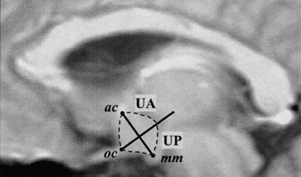 Segmentation and subdivision of the hypothalamus into 2 regions of interest (20). Ac, anterior commissure; mm, mammillary body; oc, optic chiasm; UA, upper anterior hypothalamus; UP, upper posterior hypothalamus.