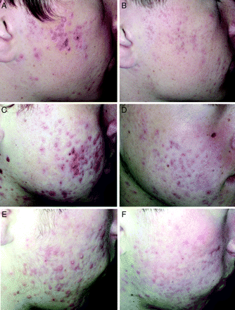Photographs of acne improvement in the low-glycemic-load group. A and B: subject A at baseline and 12 wk respectively; C and D: subject B at baseline and 12 wk, respectively; and E and F: subject C at baseline and 12 wk, respectively.