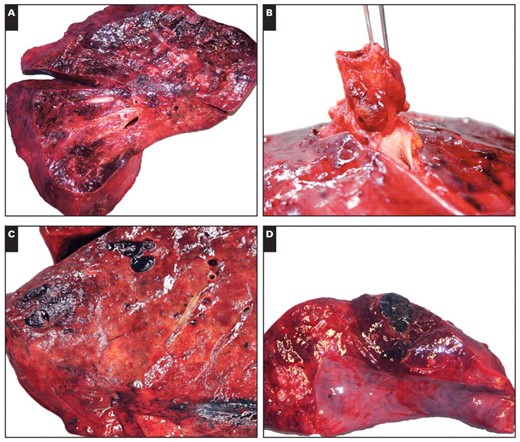 Macroscopic findings in fatalities of novel H1N1 influenza. A, Cut surface of lung with central consolidation and evidence of diffuse alveolar damage. B, External surface of lung with subpleural nodularity and hilar lymphadenopathy. C, Cut surface of lung displaying peripheral pulmonary thrombi. D, Cut surface of lung with focal hemorrhagic infarction.