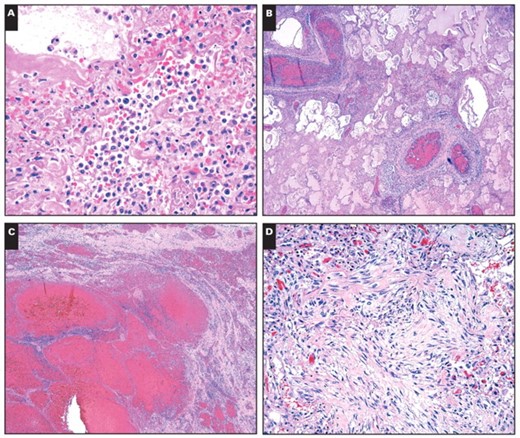 Pulmonary histopathology in fatalities of novel H1N1 influenza. A, Acute interstitial inflammation accompanied by acute diffuse alveolar damage with hyaline membranes (H&E, ×400). B, Thrombi in pulmonary arteries (H&E, ×40). C, Acute hemorrhage without organization (H&E, ×40). D, Organizing diffuse alveolar damage with fibrosis (H&E, ×200).