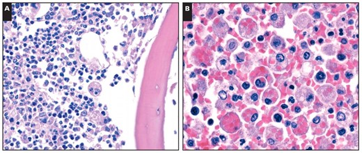 Hemophagocytosis in deaths of novel H1N1 influenza. A, Cytophagocytosis in bone marrow (H&E, ×600). B, Hemophagocytosis in spleen (H&E, ×400).