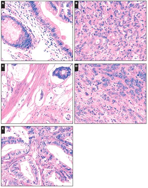 Histologic subtypes of carcinoma of the papilla of Vater. A, Intestinal. B, Pancreatobiliary. C, Mucinous. D, Poorly differentiated. E, Mixed (A–E, H&E, ×200).