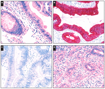 Immunophenotype of intestinal (A, B, and C) and mixed (D, E, and F) types of carcinomas of the papilla of Vater (A and D, H&E, ×200; B and E, anti-cytokeratin 20 antibody, H&E, ×200; C and F, anti-cytokeratin 7 antibody, H&E, ×200).