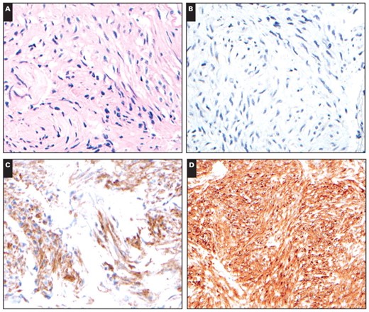 An example of a gastrointestinal stromal tumor in which the initial cell block material (A, ×400) obtained by endoscopic ultrasound–guided fine-needle aspiration was negative for KIT (B, ×400) but strongly positive for DOG1 (C, ×400). Subsequently, the patient underwent a gastric wedge resection, and the surgical specimen was strongly positive for KIT (D, ×400).