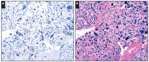 A, DOG1 showed weak, focal staining in 1 of 25 leiomyosarcoma cell blocks (×400). B, The H&E stain demonstrated marked nuclear pleomorphism (×400), which would be highly unusual for a gastrointestinal stromal tumor.