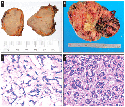A, Gross photograph of a myxoid adrenocortical adenoma. On the cut surface, the majority of the adrenocortical adenoma had yellow-grayish regions with gelatinous myxoid areas admixed with areas of firm and fibrous consistency. B, Gross photograph of a myxoid adrenocortical carcinoma. The section showed obvious areas of hemorrhage and necrosis. C, A myxoid adrenocortical adenoma showed anastomosing cords of tumor cells (H&E, ×200). D, Prominent pseudoglandular pattern in a background of myxoid stroma (H&E, ×200). E, In the myxoid matrix are floating clusters of cells (H&E, ×200). F, A microcystic pattern in the myxoid background (H&E, ×100). G, A myxoid adrenocortical carcinoma demonstrated sheets and solid patterns and obvious areas of hemorrhage (H&E, ×10). H, Under high magnification, the neoplastic cells showed abnormal mitosis (arrows) (H&E, ×400).