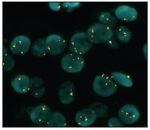 The myxoid adenoma cells show high polysomy of epidermal growth factor receptor (EGFR) by fluorescence in situ hybridization. Green signals represent the chromosome 7 centromere; red signals, the EGFR gene.