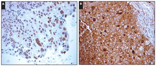 (Case 06) Sections of a selected formalin-fixed, paraffin-embedded block from right parietal brain tumor. Immunohistochemical studies revealed positive nuclear staining for CDX2 (A, ×400) and positive cytoplasmic staining for carcinoembryonic antigen (B, ×400).