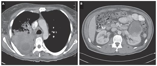 Computed tomography scan results. A (Case 16), A dominant heterogeneous necrotizing tumor-consolidative process in the right upper lobe of the lung. B (Case 24), A 7-cm3 mass on the left kidney.