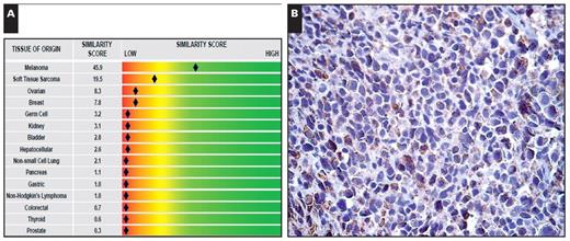 (Case 17) Melanoma cell type identification. A “melanoma” expression profile according to the Pathwork Tissue of Origin Test report (A) and positive immunohistochemical staining using a melanoma cocktail containing HMB-45, MART-1 (melan-A), and tyrosinase antibodies (B, ×400).