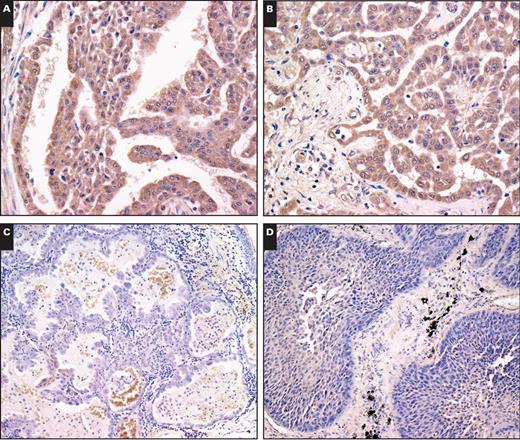 Representative immunohistochemical staining of clinical specimens. Two different samples of epithelioid mesothelioma (A, ×20; B, ×20), lung adenocarcinoma (C, ×10), and lung squamous cell carcinoma (D, ×10) were stained with anti-CD90 antibody.