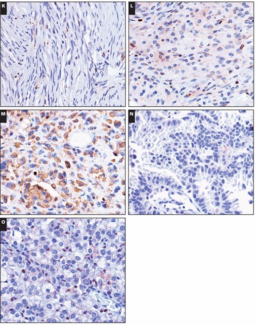 Immunohistochemical stains for 5-lipoxygenase (5-LO) in central nervous system tumors. Weak to moderate nuclear immunoreactivity of 5-LO was detected in the following tumors (×400): (A) diffuse astrocytoma, (B) anaplastic astrocytoma, (C) oligodendroglioma, (D) glioblastoma, and (E) myxopapillary ependymoma. Immunohistochemical stains for 5-lipoxygenase (5-LO) in central nervous system tumors. Weak to moderate nuclear immunoreactivity of 5-LO was detected in the following tumors (×400): (F) classic ependymoma, (G) tanycytic ependymoma, (H) anaplastic ependymoma, (I) medulloblastoma, and (J) atypical teratoid/rhabdoid tumor. Immunohistochemical stains for 5-lipoxygenase (5-LO) in central nervous system tumors. Weak to moderate nuclear immunoreactivity of 5-LO was detected in the following tumors (×400): (K) fibrous meningioma, (L) meningothelial meningioma, (M) anaplastic meningioma, (N) cerebral metastatic lung papillary adenocarcinoma, and (O) cerebral metastatic lung solid adenocarcinoma with mucin production.