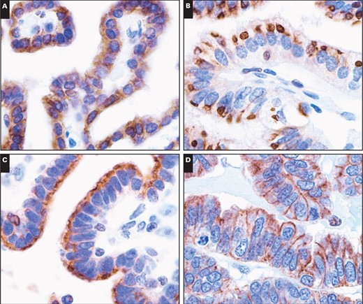 Patterns of 5-lipoxygenase immunoreactivity in tumor cells of the choroid plexus (×1,000). A, Diffuse, strong cytoplasmic immunoreactivity. B, Paranuclear dot-like to globule-like immunoreactivity. C, Immunopositivity limited to the free luminal borders of the cells in papillae, producing a line along the outer margin of the papillae without any staining in the perinuclear cytoplasm or that close to the central blood vessels. D, Circumferential membranous immunoreactivity.