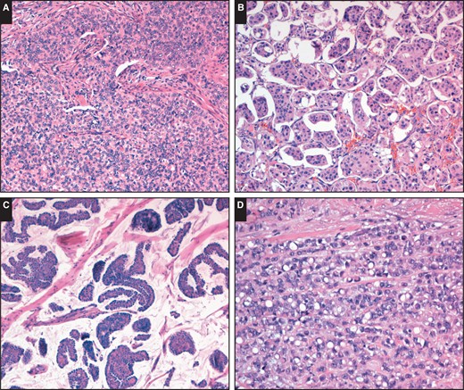 Although most carcinomas were ductal, no special type, there was a trend toward a solid-papillary growth pattern (A; H&E, ×100). Other tumor types were also noted. B, Micropapillary growth pattern (H&E, ×100). C, Mucinous carcinoma (H&E, ×100). D, Pleomorphic lobular carcinoma with signet ring cells (H&E, ×200).