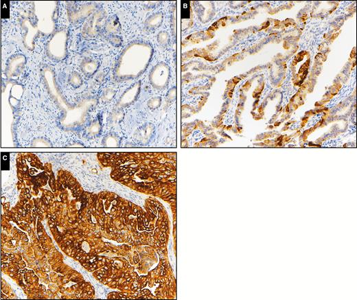Keratin 17 immunohistochemical expression in invasive adenocarcinoma. A, Low K17 expression (×200). B, Intermediate K17 expression (×200). C, High K17 expression (×200).