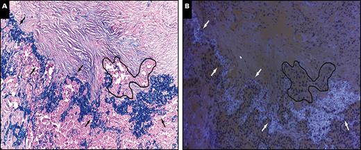 Example of visceral pleural invasion diagnosis by elastic staining under a light microscope (A) and frozen section autofluorescence under a fluorescence microscope (B) from two serial tissue sections. Arrows indicate the elastic layer of the visceral pleural and the black line indicates the cluster of tumor cells invading beyond the elastic layer. (A and B, ×100).