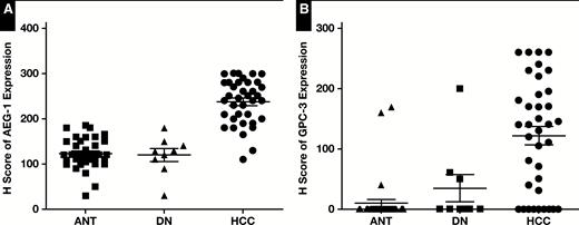 Quantitative data showed the expression level of astrocyte elevated gene-1 (AEG-1) (A) and glypican-3 (GPC-3) (B) in hepatocellular carcinoma (HCC) was significantly higher than in adjacent nontumor tissue (ANT) and dysplastic nodules (DN) (P < .001).