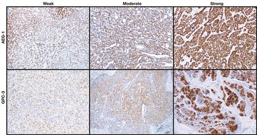 Expression of astrocyte elevated gene-1 (AEG-1) and glypican-3 (GPC-3) in hepatocellular carcinoma and adjacent nontumor tissue. Representative images show immunostaining densities of AEG-1 and GPC-3 (x100).