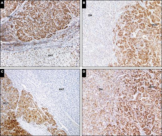 Expression of glypican-3 (GPC-3) (A and B) and astrocyte elevated gene-1 (AEG-1) (C and D) in hepatocellular carcinoma (HCC) and adjacent nontumor tissue (ANT). Strong AEG-1 or GPC-3 expression was seen in HCC compared to ANT and dysplastic nodules (DN) (x100).