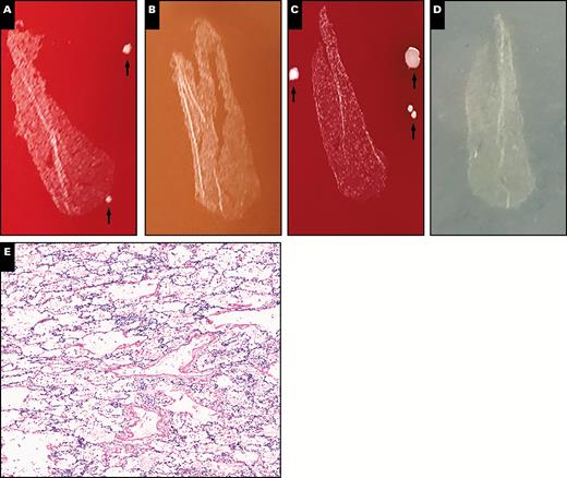 Representative plate photos and histology of cases called negative for infection (case PC3B). A-D, Isolated, rare colonies are present in the media section and on the tissue surface (arrows) but are not present in the tissue section itself. A, Blood. B, Chocolate agar. C, Anaerobic. D, Fungal. E, Histologically bland-appearing lung parenchyma without evidence of inflammation is demonstrated (x10).