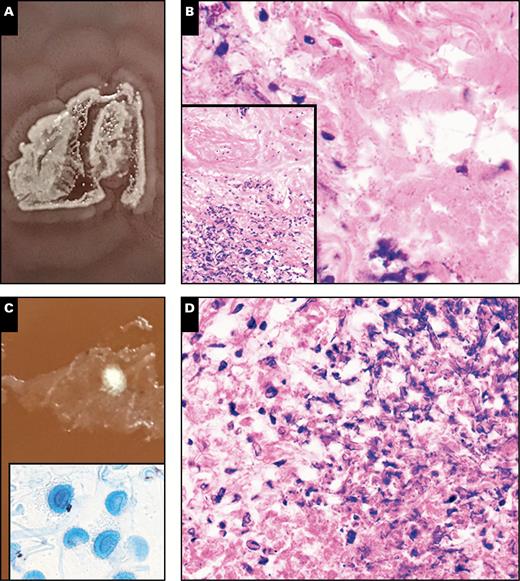 Representative photos of two cases of infections caused by single organisms (A and B, case PC13; C and D, case PC8B). A, A plate photo demonstrating heavy growth of Proteus mirabilis on chocolate agar, with a classic swarming motility pattern of growth. B, High-power (x40) histologic view of microorganisms at an interface of necrotic and viable tissue within the tissue section (inset, low power (x10) view of interface). C, Plate photo demonstrating a single filamentous colony, which upon scotch-tape preparation and staining with lactophenol-cotton-blue demonstrated fruiting bodies consistent with Aspergillus fumigatus (inset) (x40). D, High-power (x40) histologic view of the area where the filamentous colony grew, demonstrating hyphal forms and necrosis, consistent with an invasive fungal infection.