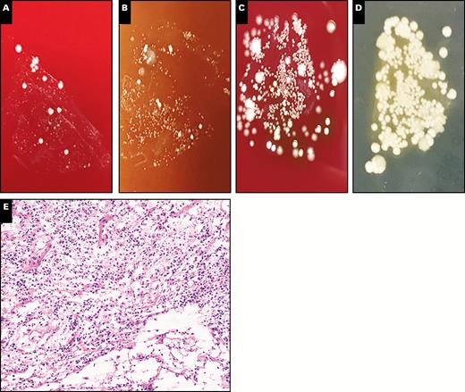Representative plate photos and histology demonstrating a mixed infection (case PC5B). A-D, Different media demonstrated a variety of microbial colonies, including yeast colonies. A, Blood. B, Chocolate agar. C, Anaerobic. D, Fungal. E, Histologically, there is evidence of acute inflammation and tissue destruction, consistent with an active infection (x10). The patient had a history of aspiration pneumonia, which was confirmed both microbiologically and histologically using printculture.