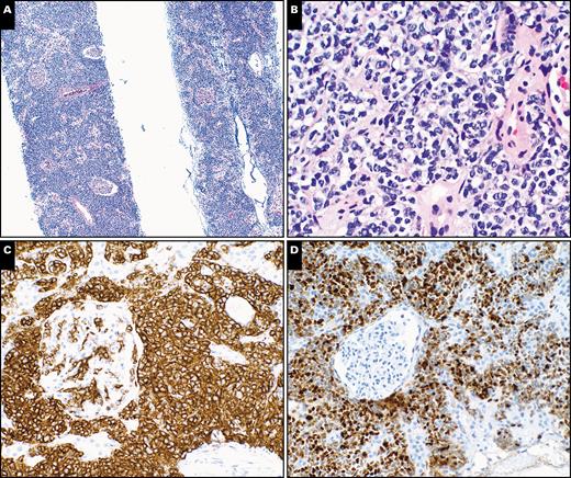 Histopathologic evaluation of a core needle biopsy of kidney with a diffuse large B-cell lymphoma, germinal center phenotype, in a 68-year-old female patient with a remote history of large B-cell lymphoma. A, H&E-stained needle core section shows renal tissue with an interstitial infiltrate of lymphoid cells. Note the relatively intact glomeruli (×40). B, High magnification shows medium-sized to large lymphoid cells with irregular nuclear contours, vesicular chromatin, and moderate amount of clear cytoplasm in renal interstitial space (H&E, ×400). C, Stain for CD20 highlights interstitial infiltrate of the medium-sized to large lymphoid cells (×200). D, Ki-67 stain shows an increased proliferative index of the interstitial lymphoid cells (×200).
