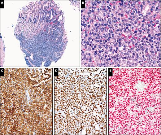 Histopathologic evaluation of upper gastrointestinal endoscopic biopsy of stomach lesion with plasmablastic lymphoma in a 58-year-old male patient. A, H&E-stained section shows gastric mucosa with submucosal infiltrate of lymphoid cells (×40). B, A high magnification shows morphologic features of large lymphoid cells. Note the relatively abundant cytoplasm in abnormal large cells and increased apoptotic bodies (H&E, ×400). C, The large cells are positive for CD138 (×200). D, Stain for OCT2 highlights the large lymphoid cells (×200). E, Epstein-Barr virus-encoded small RNAs in situ hybridization shows positive staining in the large lymphoid cells (×200).