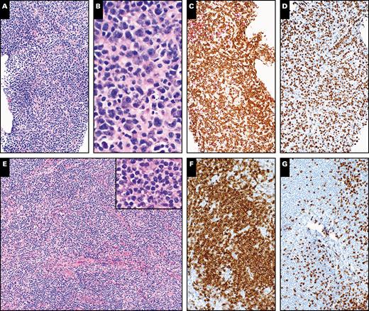 Histopathologic evaluation of an ultrasound-guided core needle biopsy of a right groin lymph node and subsequent excisional biopsy of the same lymph node showing chronic lymphocytic leukemia/small lymphocytic lymphoma in a 52-year-old male patient. A, H&E-stained section of the initial needle core biopsy shows lymphoid tissue without appreciable follicular architecture (×100). B, A high magnification shows small to medium-sized lymphoid cells (×400). C, CD3 stain shows many positive cells (×100). D, Increased proliferative index highlighted by Ki-67 stain (×100). E, H&E-stained section of subsequent excisional biopsy shows lymphoid tissue with nodal architecture effaced by predominantly small to medium-sized lymphoid cells (×100). Inset shows small to medium-sized lymphoid cells at high magnification (×400). F, Stain for CD20 highlights the small lymphocytes (×100). G, CD3 stain demonstrates fewer T cells that are small in size (×100).