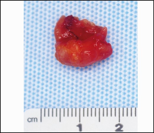 Gross image. Lymph node with surrounding adipose tissue. Gross extranodal extension is generally an indication for axillary lymph node dissection.