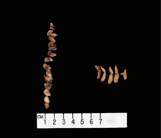 Gross image. Two lymph nodes of near-equal size sectioned perpendicular to the long axis (left) and parallel to long axis (right).