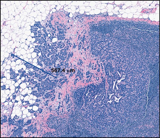 Extent of extranodal extension (H&E, ×6). Extranodal extension is emerging as a predictor of non–sentinel lymph node involvement and may be an indication for axillary lymph node dissection.