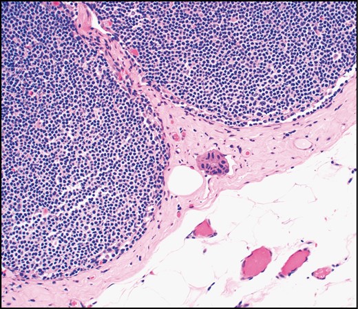 Tumor cells in pericapsular lymphatic spaces are variably interpreted as lymphovascular invasion or isolated tumor cells (H&E, ×20).