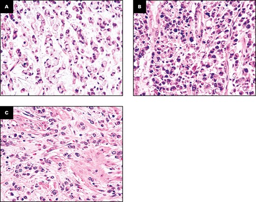 Representative images of the three histologic subtypes of small bowel poorly cohesive carcinomas (SB-PCCs). A, A signet ring cell (SRC)–type carcinoma, almost entirely (>90%) composed of SRCs, featuring a cytoplasmic, globoid droplet of mucin and an eccentrically placed nucleus. B, A combined poorly cohesive not otherwise specified and SRC carcinoma, characterized by a neoplastic growth comprising both an SRC (10%-90%) and a non-SRC poorly cohesive component. C, A PCC not otherwise specified (PCC-NOS), featuring a dyshesive cell invasion pattern and composed of less than 10% of SRCs. (H&E, ×400.)