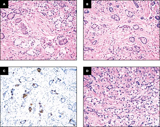 Histologic features of the ileal RHOA-mutated small bowel carcinoma. A superficial, minor portion of the neoplasm shows a low-grade goblet cell adenocarcinoma-like component with cohesive tumor cell clusters, including goblet-like cells with clear cytoplasm (A, B) and synaptophysin-positive neuroendocrine cells (C), while the deeper part of the cancer (D, on the lower left) features a poorly cohesive cell pattern, which accounts for more than 50% of the neoplasm. (A, B, D, H&E; C, synaptophysin immunostaining; A, ×200; B, ×100; C, ×100; D, ×400.)