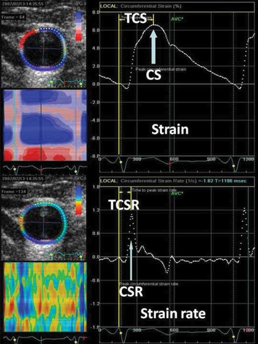 Strain curve (upper panel) and strain rate curve (lower panel) derived from speckle tracking echocardiography on the carotid artery. Peak circumferential strain (CS) (arrow in upper panel) or CSR circumferential strain rate (CSR) (arrow in lower panel) was identified as value of the first upward peak after ventricular systole from the global strain curve or the global strain rate curve, respectively. Time to peak circumferential strain (TCS) (upper panel) or time to peak circumferential strain rate (TCSR) (lower panel) was measured from the beginning of the QRS wave on each electrocardiographic beat to peak CS or to peak CSR, respectively.
