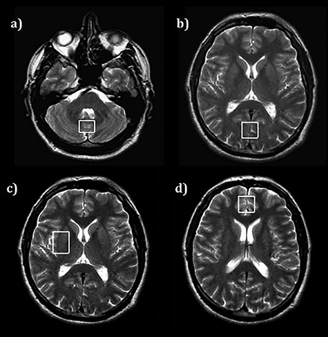 The MR signal was acquired from a) cerebellum, b) occipital lobes (centrally), c) basal ganglia (in right hemisphere), d) frontal lobes (centrally).