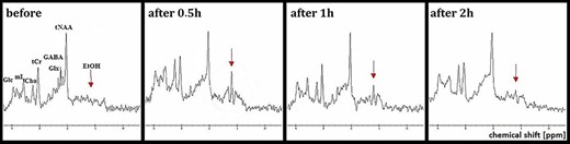 Changes in 1HMRS in the frontal lobes after drinking alcohol shown at the example spectra of a single subject; the arrow indicates the peak corresponding to ethanol.