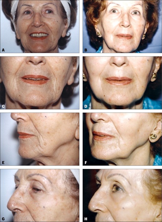 A, C, E, G, Preoperative views of a 73-year-old woman. B, D, F, H, Postoperative views 8 months after full-face resurfacing with the Visage Coblation system. Two passes were made in the periorbital area and 4 passes in all other areas at maximum voltage (175 V). Note the improvement of fine and deep rhytids and the change in skin texture and color.
