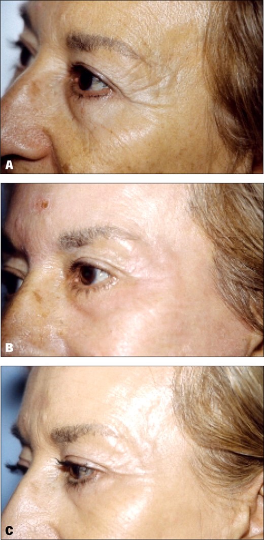 A, Preoperative view of a 63-year-old woman. B, Postoperative view 5 days after periorbital resurfacing with 2 passes at 175 V. Note the complete reepithelization with minimal swelling and erythema. C, Postoperative view at 6 months shows good improvement of crow's-feet lines.