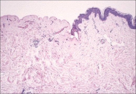 Photomicrograph of tissue treated with 2 passes at 75 V shows complete epidermal exfoliation.