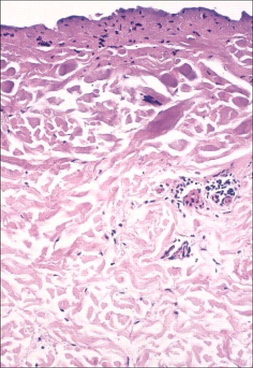 Photomicrograph of tissue treated with 4 passes at 175 V shows layer of thermal coagulative necrosis of the collagen.