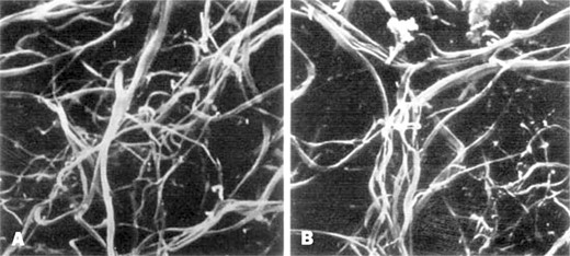 Figure A. The fibrin matrix created by the Tisseel fibrin sealant (original magnification X6000) mimics B, that of a natural fibrin matrix (original magnification X6000). (© 2000 by Baxter International. Used with permission.)